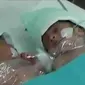 Bayi kembar siam dempet perut ini dinyatakan kritis dan dapat mengancam jiwanya.