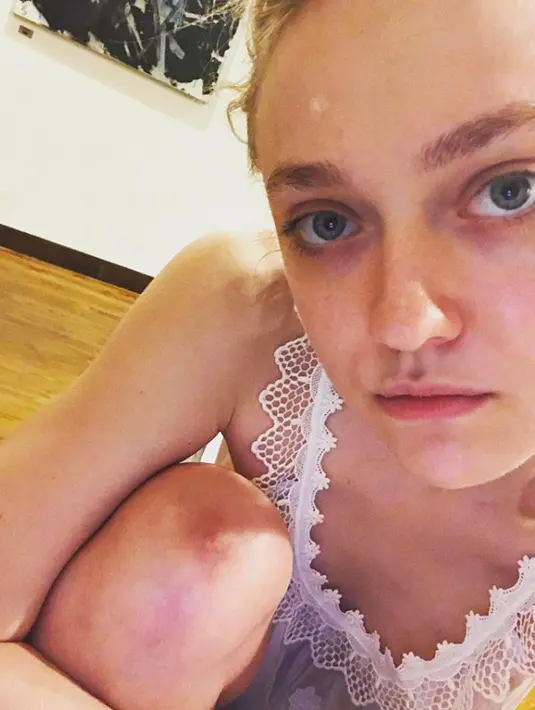 Dakota Fanning pun terlihat masa bodo dengan pamer obat jerawat di wajahnya. (instagram/HollywoodLife)