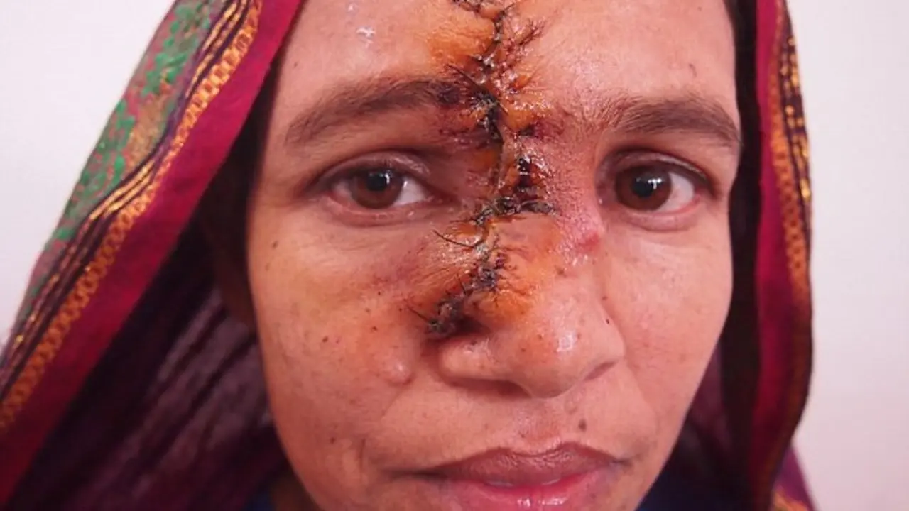Punya Tumor di Wajah, Wanita India Ini Tak Pernah Dicium Suaminya. Source: HealthMedicineNetwork