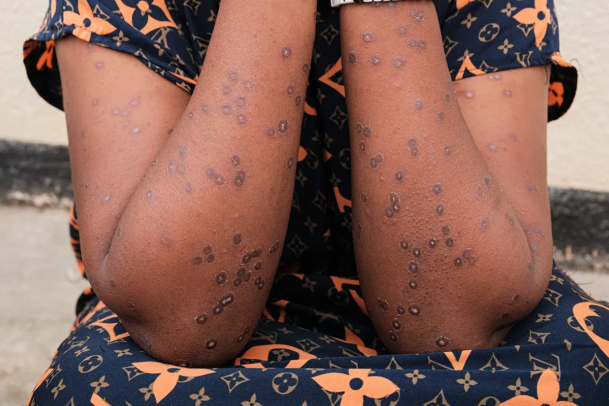 Burundi Mencatat 171 Kasus Mpox