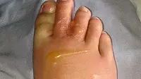 Bengkak di Kaki Tak Kunjung Sembuh? Ini Cara Alami dan Medis untuk Menghilangkannya