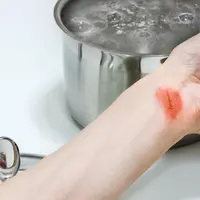 Ilustrasi luka bakar/Shutterstock. 