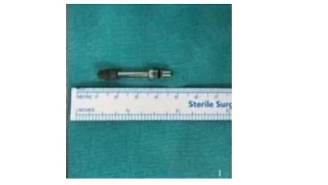 Beruntung, Pria Ini Tetap Hidup Usai Ditemukan Sekrup Implan Gigi Masuk ke Rongga Otak