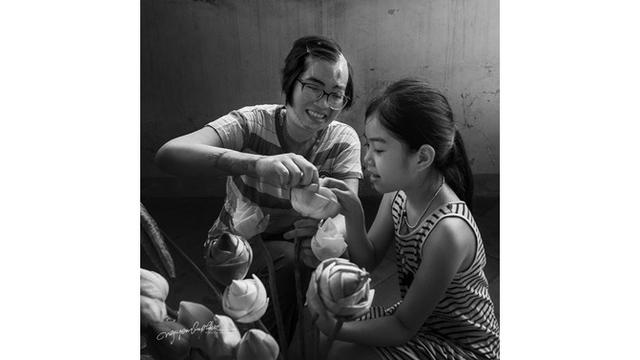 Potret Perjuangan Wanita yang Disiram Air Keras Oleh Mantan Suami Ini Bikin Miris