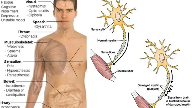 [Bintang] Mengenal Multiple Sclerosis, Penyakit Pepeng Jari-jari