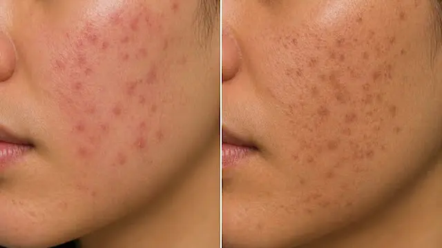 Bekas Jerawat Merah atau Hitam? Kenali PIE vs PIH Biar Nggak Salah Perawatan