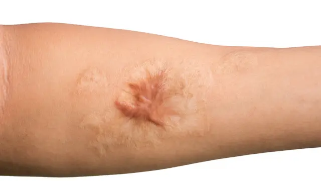 Cara Menghilangkan Keloid