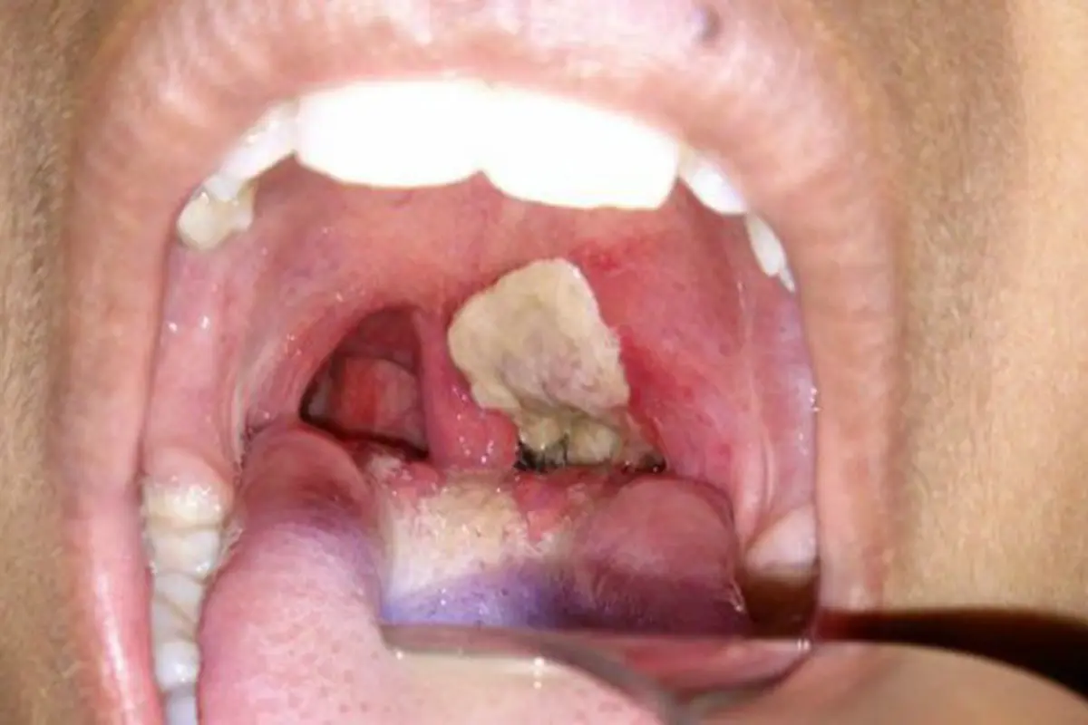 Disease (4)