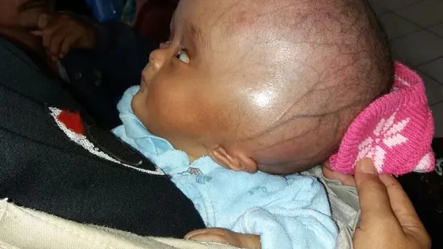 Usaha Hidup Bayi Pengidap Hidrosefalus Usai Ditinggalkan Kembaran