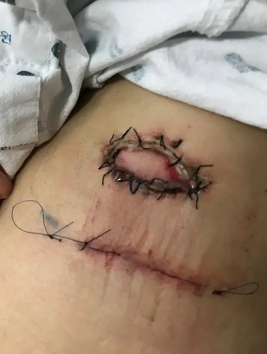 Ada luka di bagian bawah ketiak. Luka di bagian atas berbentuk oval dengan jahitan yang begitu rapi dan di sekitarnya terlihat seperti luka bakar. (Foto: instagram.com/han_ye_seul_)