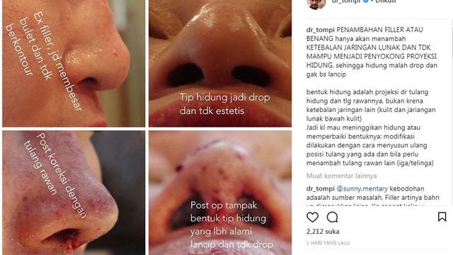 [Bintang] Berminat Tanam Benang? Coba Lihat Dulu Video yang Diunggah Oleh Dr Tompi Ini, Bikin Ngilu