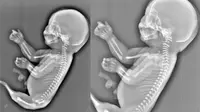 Hamil 6 Bulan Ibu Muda Terkejut Lihat Foto Bayinya Punya Ekor
