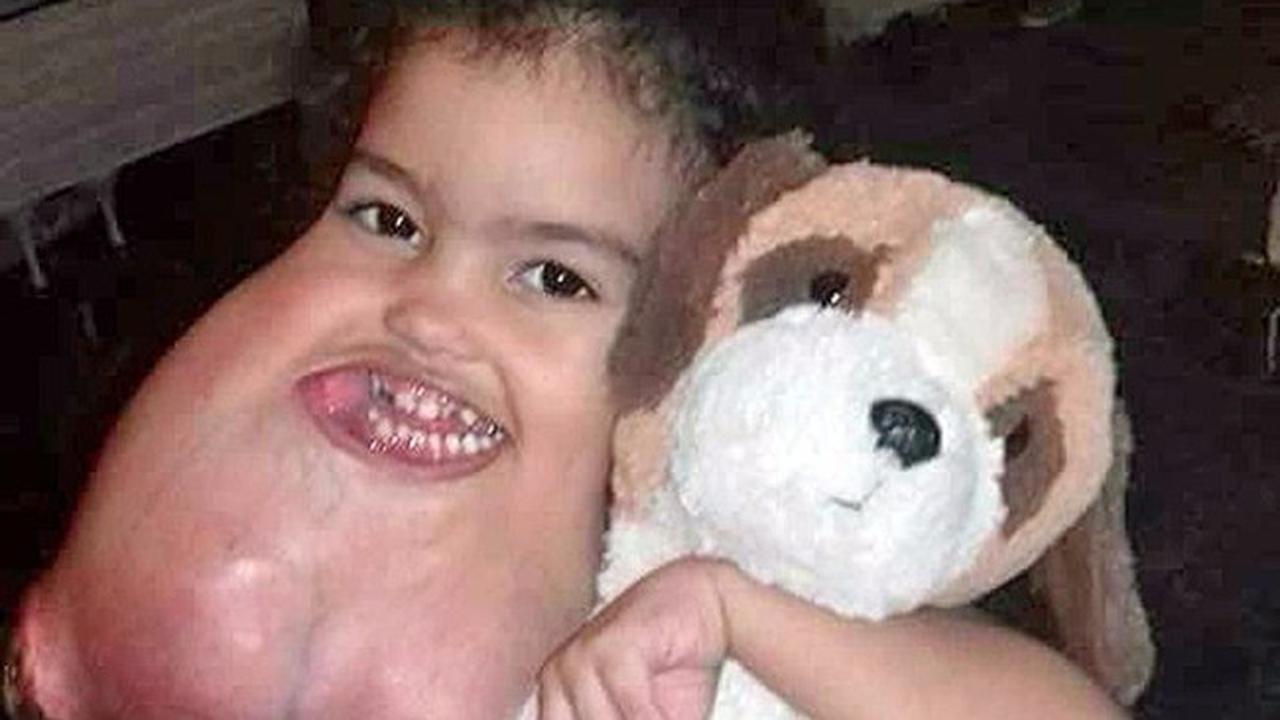 Kisah Bocah 3 Tahun dengan Separuh Tumor Raksasa di Wajahnya