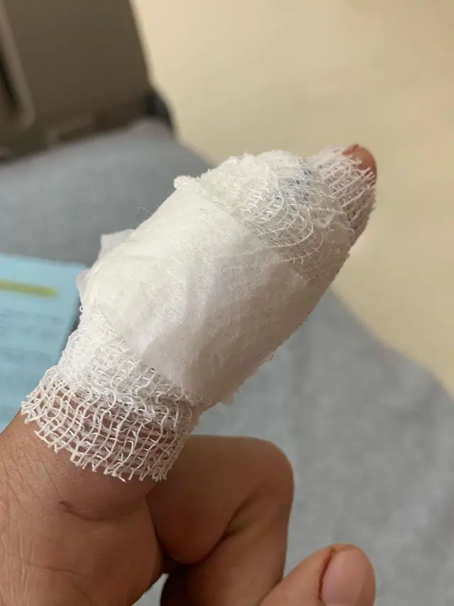 Miller Khan jalani operasi lipoma (Foto: Instagram/@miller_khan)