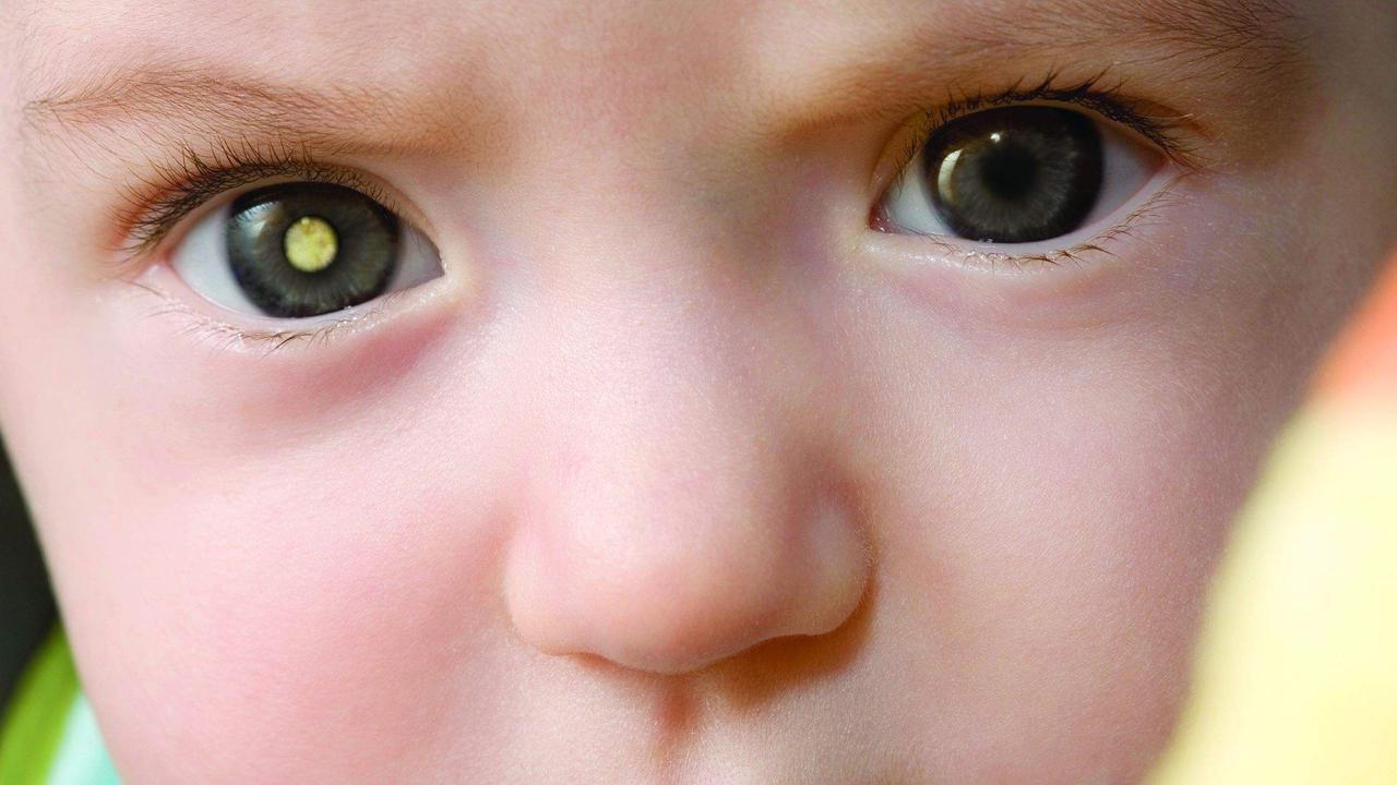 Waspadai Bila Mata Anak Mirip Mata Kucing, Bahaya