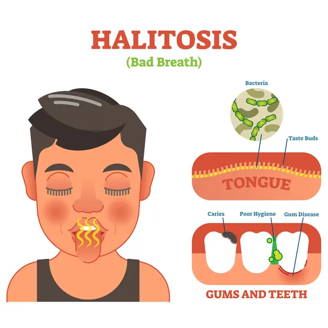 Ilustrasi halitosis atau bau mulut