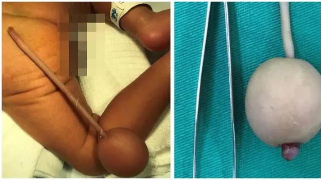 Kondisi Langka, Bayi Lahir dengan Ekor Sepanjang 12 Cm Bikin Geger