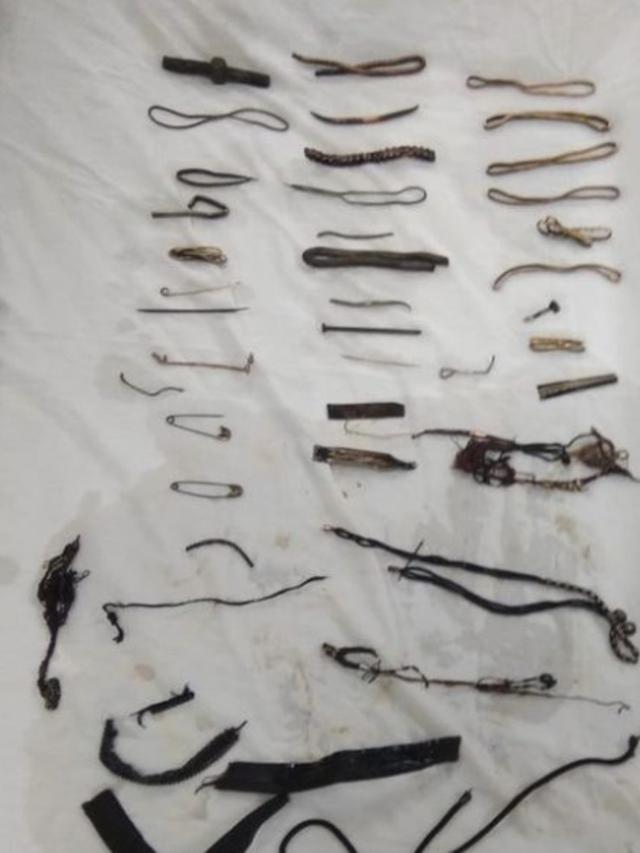 Suka Telan Benda Logam, Wanita Ini Alami Sakit Perut Tak Tertahankan