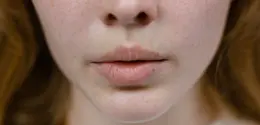 Hiperpigmentasi pasca inflamasi sering menjadi keluhan (Sumber: Pexels.com)