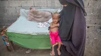 Balita di Yaman yang mengalami gizi buruk (supplied / Save the Children UK)