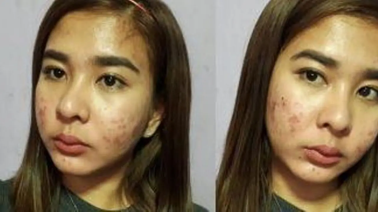 [Bintang] Dibully karena Jerawat, Wanita Ini Tampar Netizen dengan Jawaban Tegas