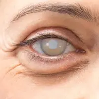 Ilustrasi. (foto: Pinterest/All About Vision).