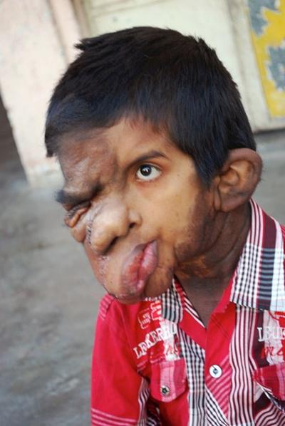 Karena wajahnya manakutkan, ia dilarang pergi ke sekolah | Photo: Copyright mirror.co.uk