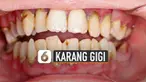 Sebelum karang gigi benar-benar muncul, berikut cara mencegahnya.