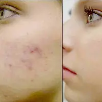 Jangan sampai bekas jerawat bikin kamu nggak pede! (via: istimewa)