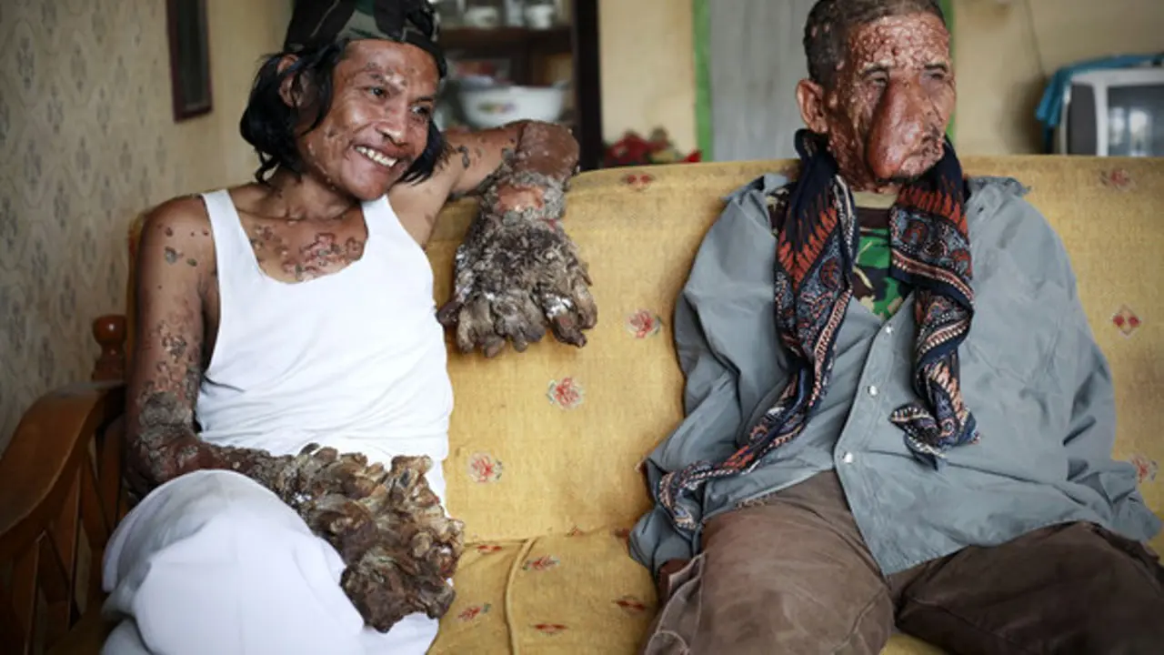 Dede Koswara 'Manusia Akar' dan Sakim 'Laki-laki Belalai'