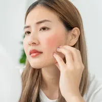 Ilustrasi kulit wajah kemerahan. (c) shisuka/Depositphotos.com