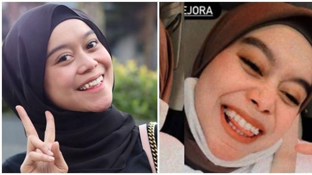 6 Beda Gaya Lesty Kejora Sebelum Vs Sesudah Pakai Behel ...
