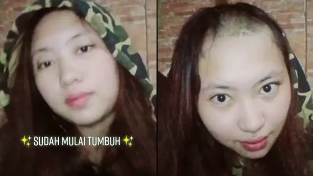 Tak Sengaja Tercukur, Rambut Bagian Depan Wanita Ini Jadi Botak