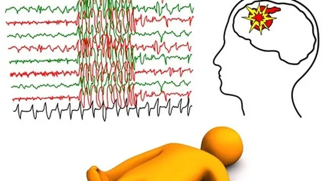 Penyakit Epilepsi