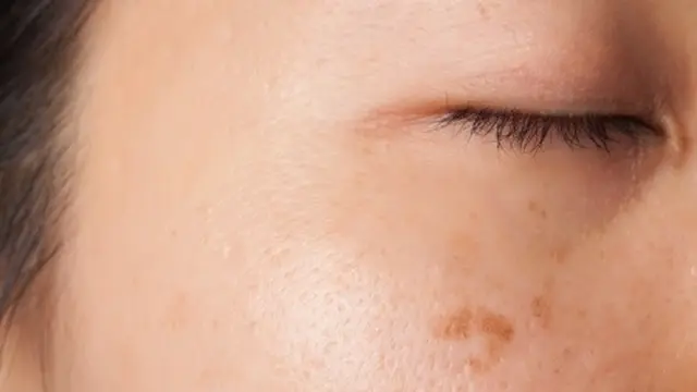 Penanganan Flek Hitam