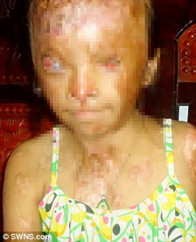 Nhi, gadis 10 tahun yang buta karena disiram air keras | Photo: Copyright dailymail.co.uk