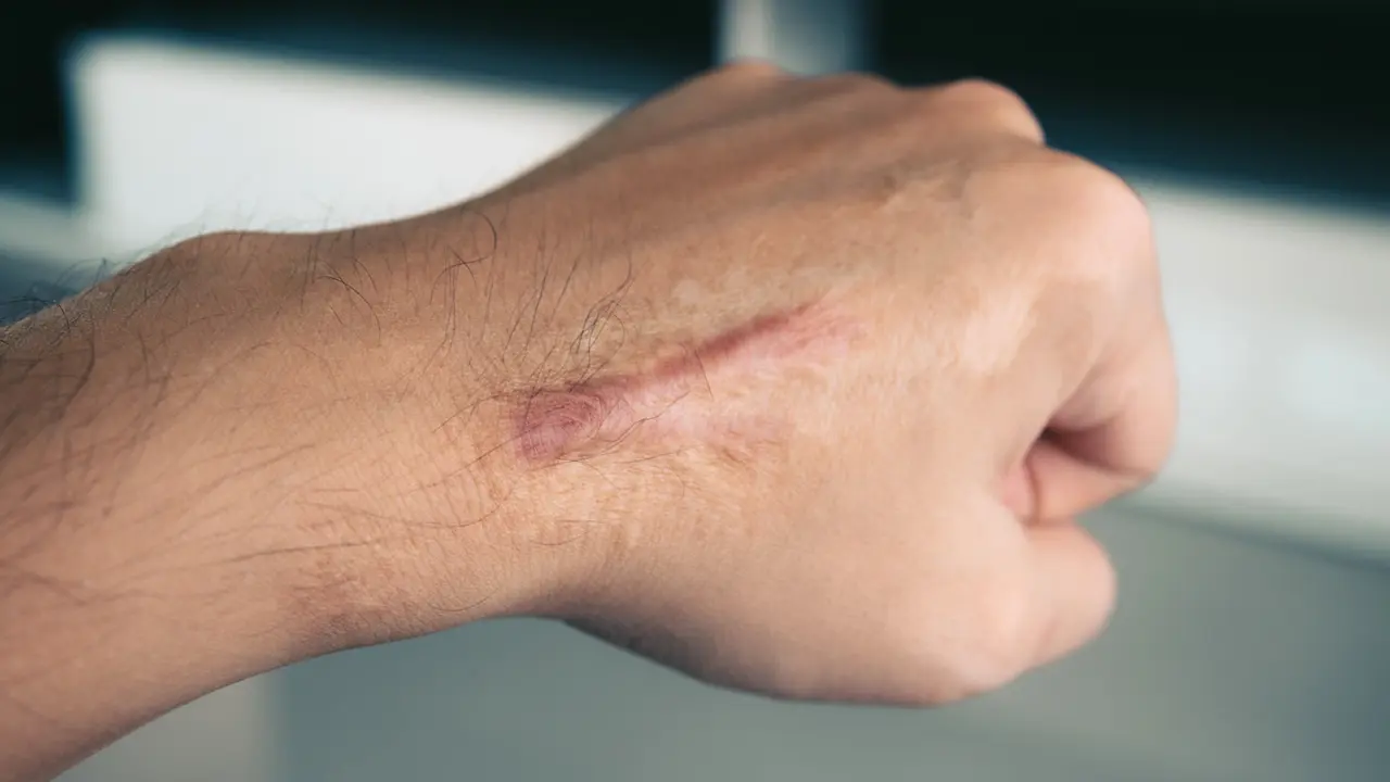 Cara Menghilangkan Keloid