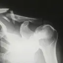 Hari Osteoporosis Sedunia: Kenali Pilihan Pengobatan dan Risiko Efek Sampingnya