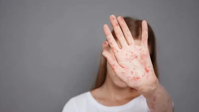 Pernah Kena Campak, Risiko Terinfeksi Lagi Sangat Kecil