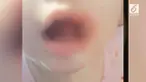Bayi asal Kentucky, Amerika Serikat, mengalami luka di bibir akibat menelan charger HP.