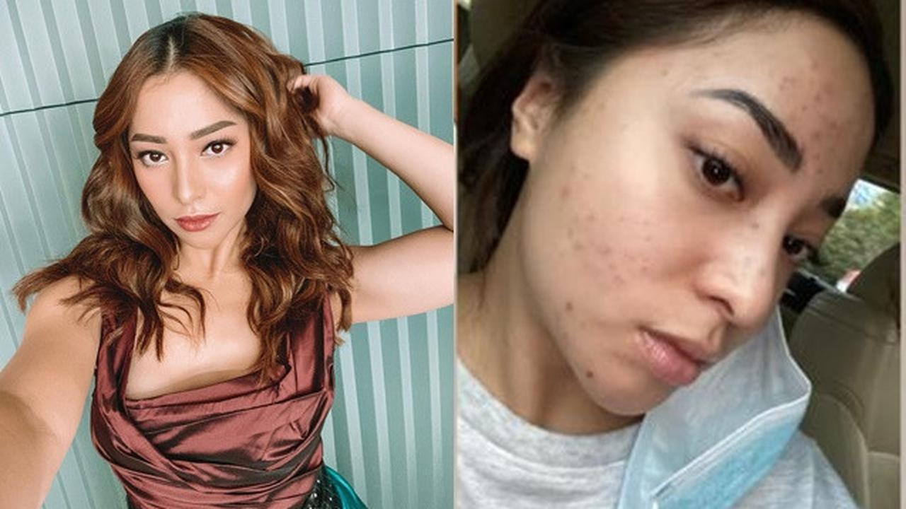 Unggah Foto Berjerawat, Ini 6 Potret Nikita Willy Tampil Natural
