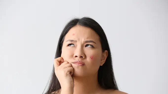 ilustrasi jerawat batu/shutterstock