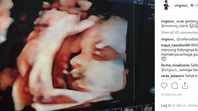 Foto calon anak kedua Virgoun melalui pemeriksaan USG (Instagram/ virgoun_)