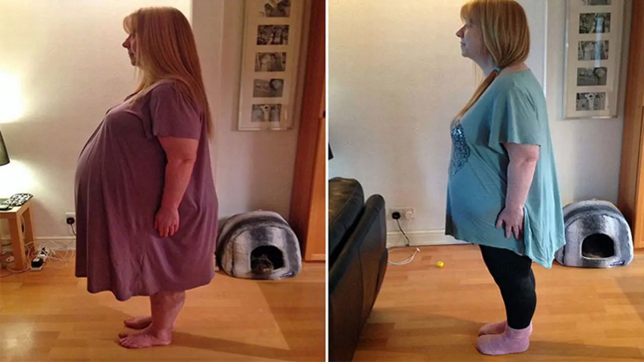 Lorna dengan Kista Ovarium 31 Kg