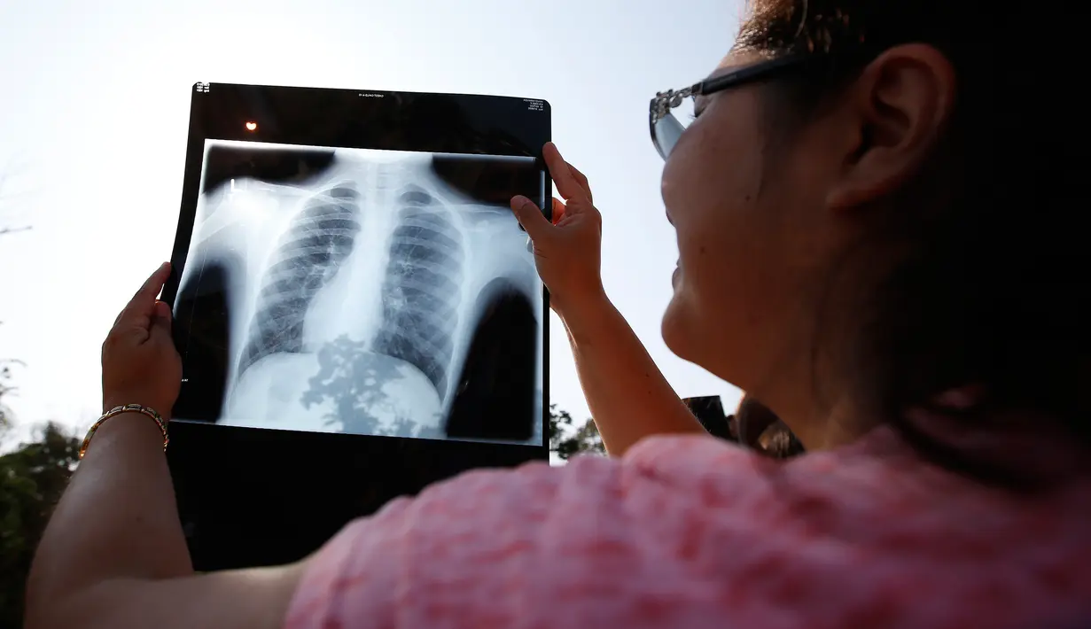 Luciane Queiroz menggunakan hasil foto rontgen untuk melihat fenomena gerhana matahari di Sacramento, California, Senin (21/8). Durasi terlama menikmati fenomena ini 2 menit 40 detik. (AP Photo/Rich Pedroncelli)