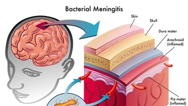 Meningitis, Infeksi Otak yang Mematikan