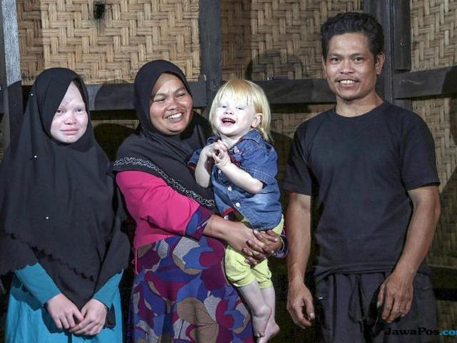 Curhat Warga Kampung Albino Dirundung Gara Gara Warna Kulit Regional Liputan6 Com