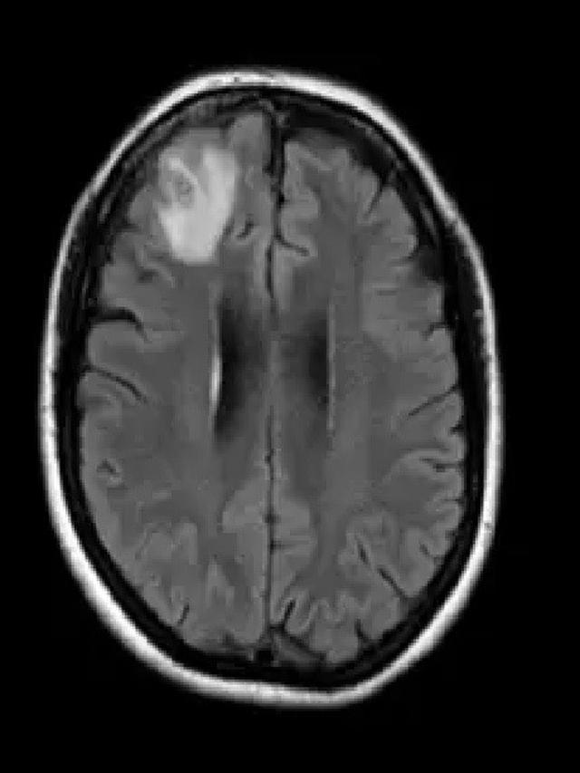 Dokter melihat kelainan otak pada pemindaian MRI pasien, yang kemudian mendorong dilakukannya operasi otak.