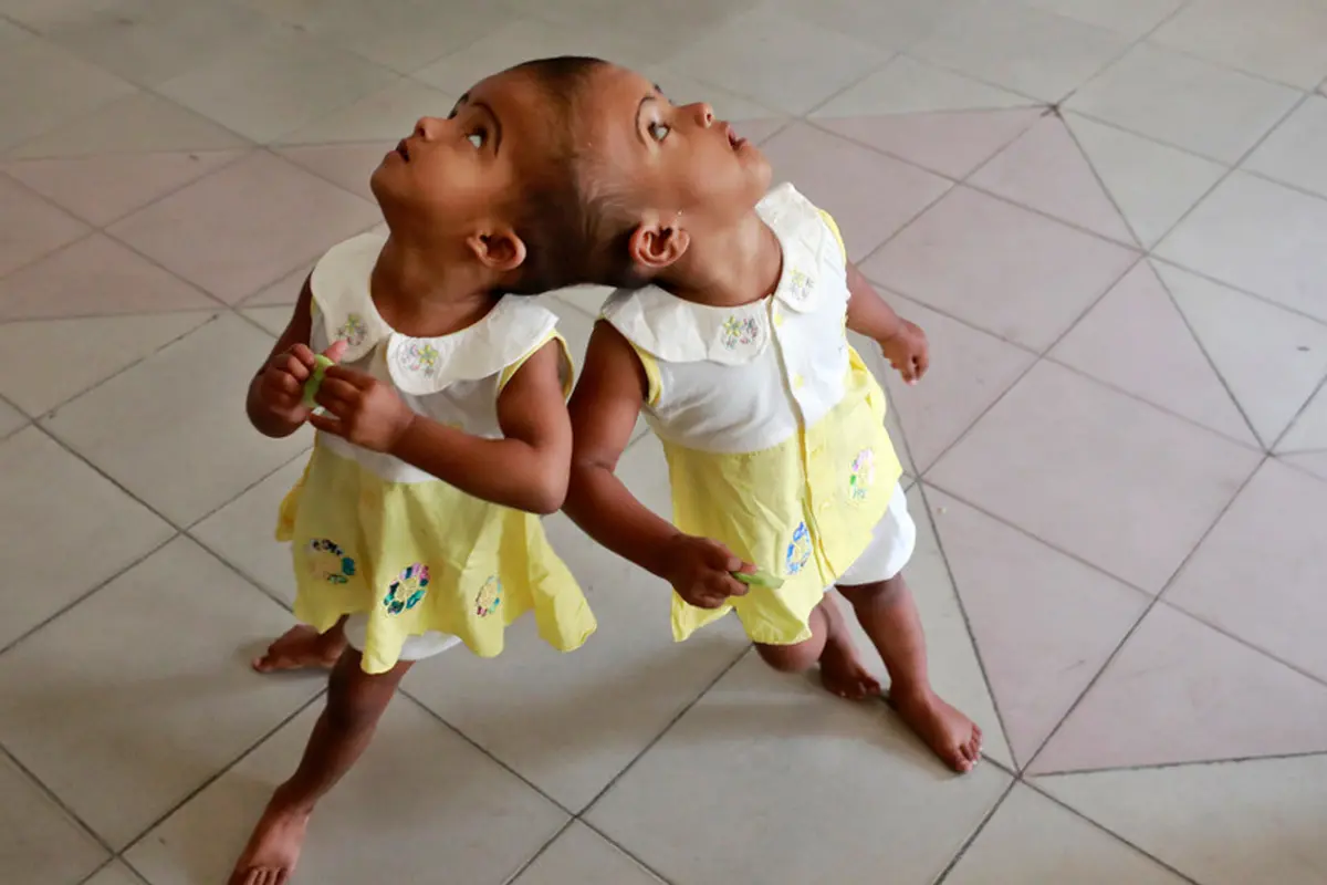 anak kembar siam