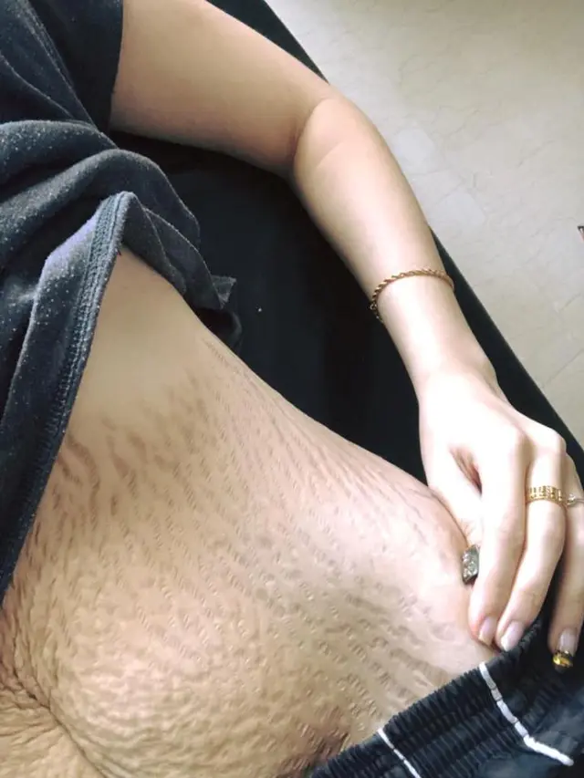 [Bintang] Pamer Stretch Marks Usai Melahirkan Empat Anak Kembar, Wanita Ini Hebohkan Dunia Maya